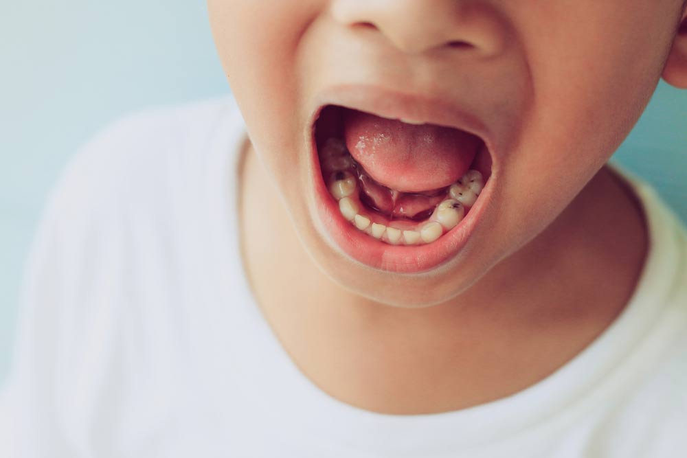 Close up child cavities